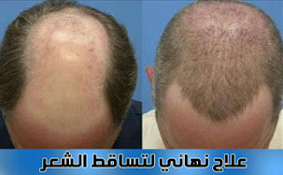 علاج تساقط الشعر بالاعشاب للدكتور سعيد حساسين