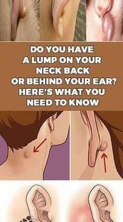 Vital Pieces of Lumps on Neck