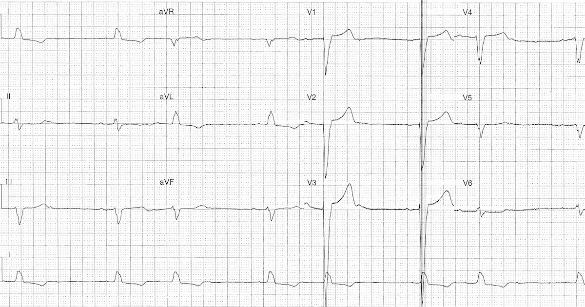 ECG of the Week ECG of the Week 19th September 2016 Interpretation