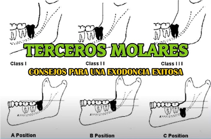 TERCEROS MOLARES: Consejos para una Exodoncia Exitosa - Dr. Andrés F. Revelo
