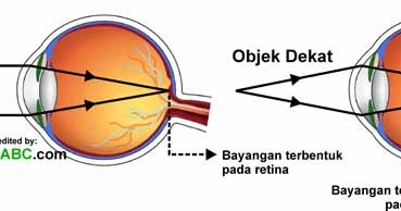 4 Jenis Cacat Mata Dan Lensa Kacamata Yang Dibutuhkan Gambar Rumus Contoh Soal Dan Pembahasan Fisikabc 4 Jenis Cacat Mata Dan Lensa Kacamata Yang Dibutuhkan Gambar Rumus Contoh Soal Dan Pembahasan Fisikabc
