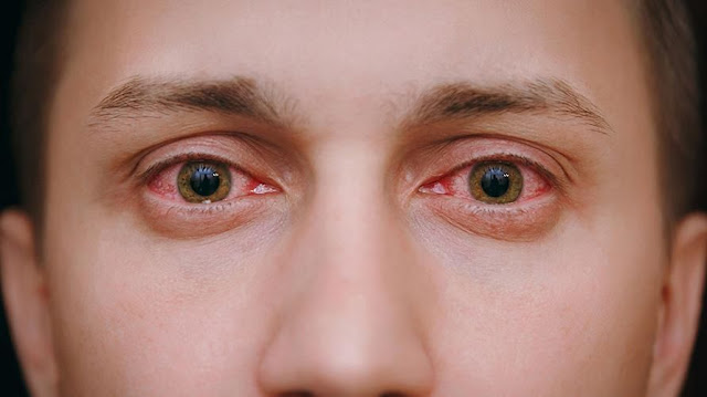 Macam Macam Penyakit Mata Yang Harus Anda Ketahui