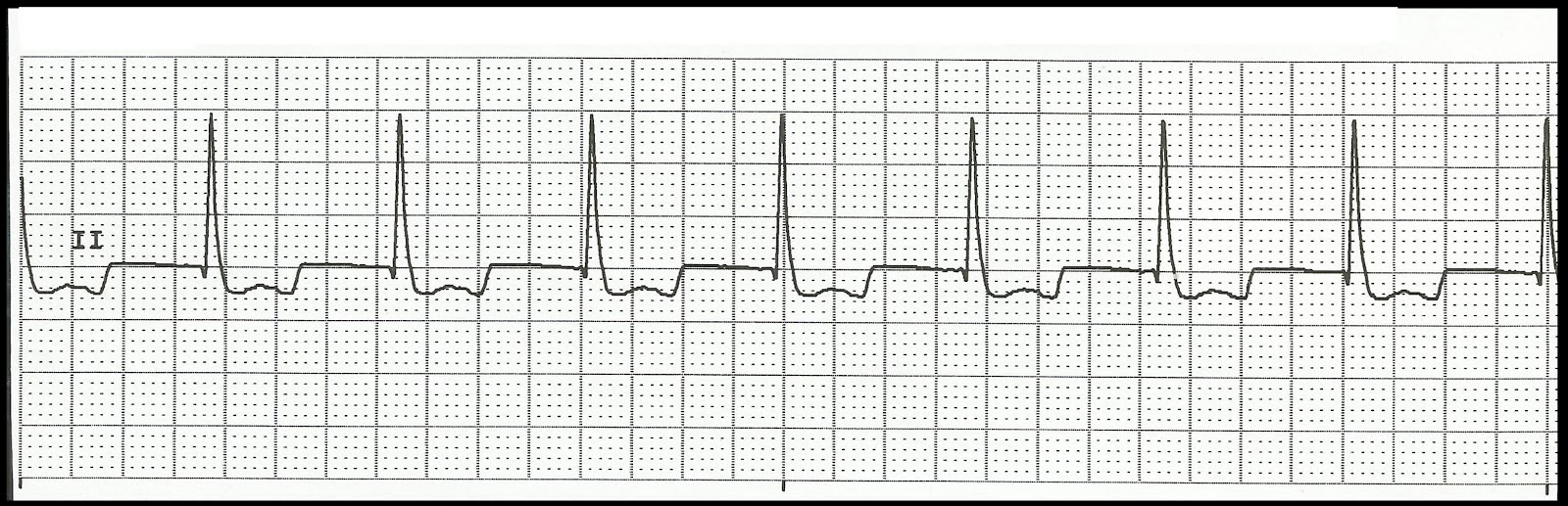 Basic ECG Rhythm Test 05