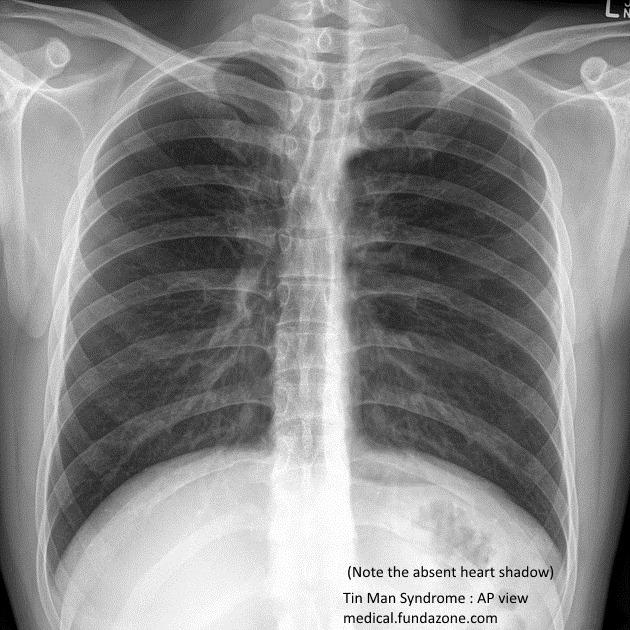 Ideaz : Tin Man Syndrome - RadioPaedia X-ray and CT scan of Ectopia ...