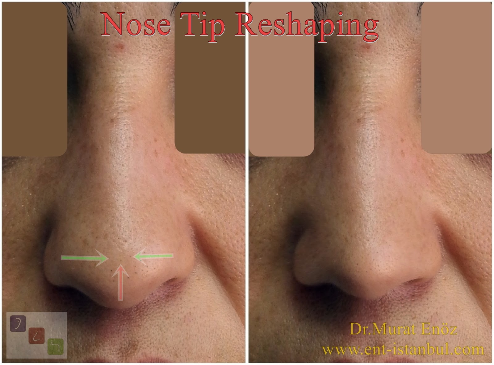 Nose Tip Surgery Cost In Istanbul