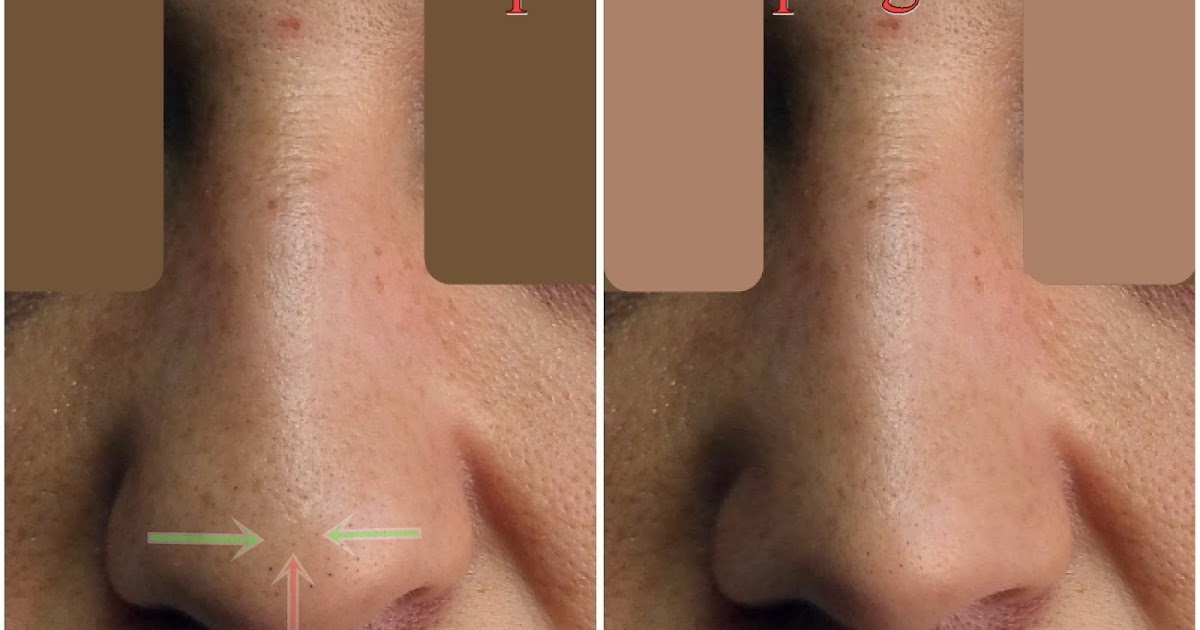 Nose Tip Surgery Cost in Istanbul