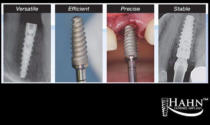IMPLANTOLOGY: The Hahn™ Tapered Implant System - Dr. Timothy Kosinski