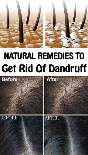 Remedies for getting rid of dandruff