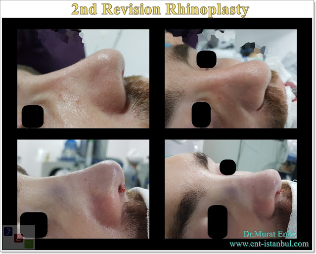 Secondary nose job istanbul, Revision rhinoplasty in men, 2nd Revision Nose Aesthetic Surgery Turkey