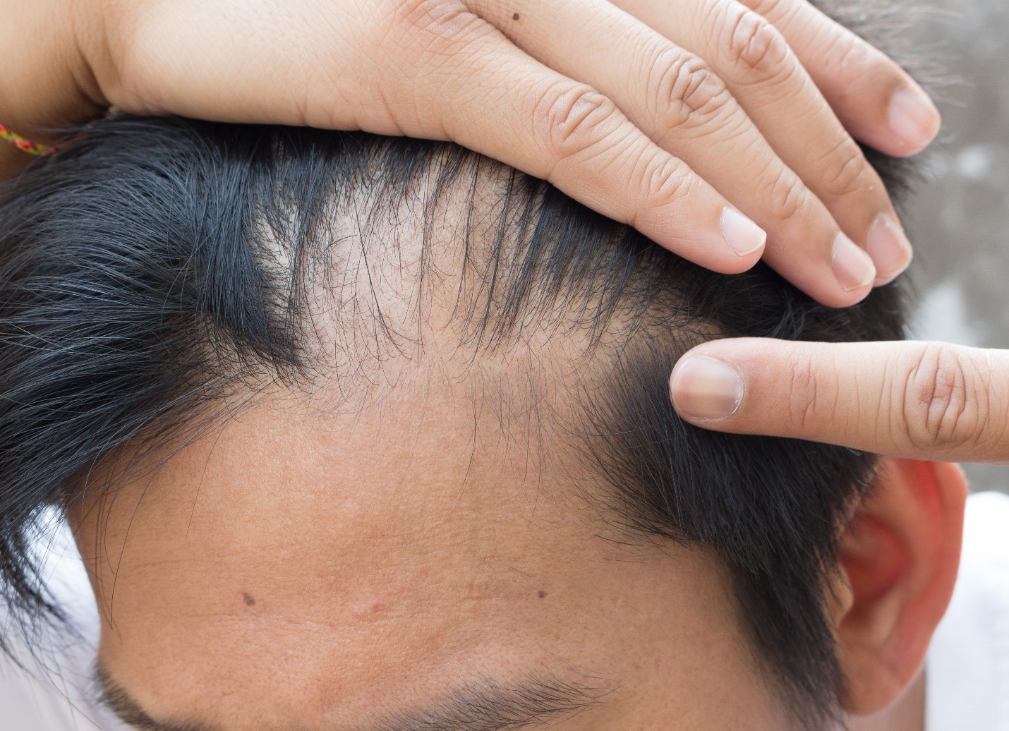 Understanding The Types Of Hair Loss To Determine The Right Solution