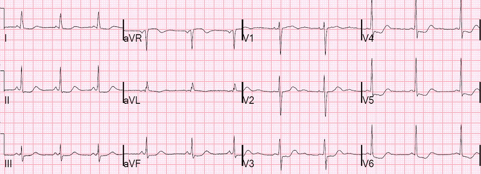 Блог по клинической электрофизиологии: Псевдоинфаркт правого желудочка