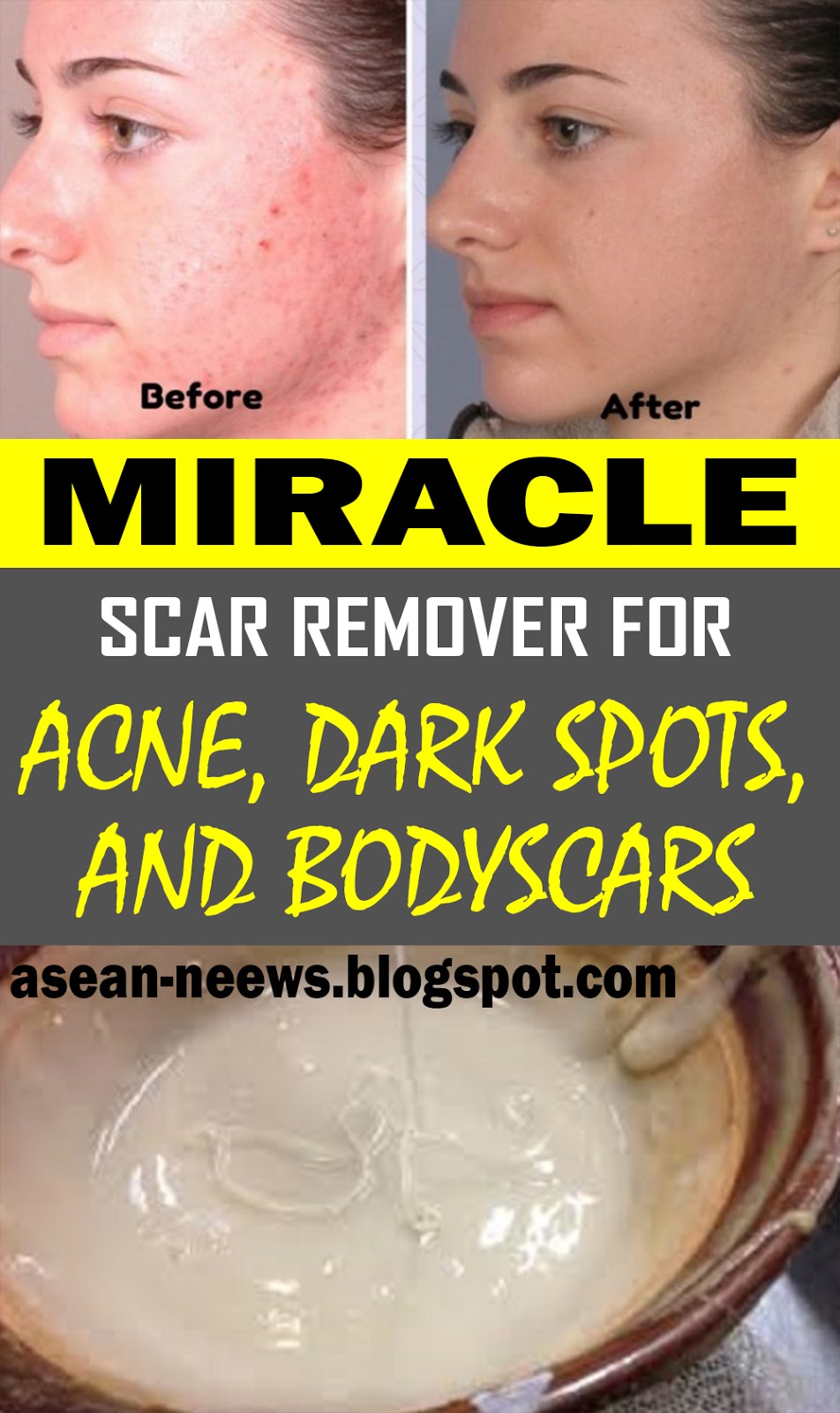 Miracle homemade scar remover for acne and dark spots - HEALTH and WELLNESS