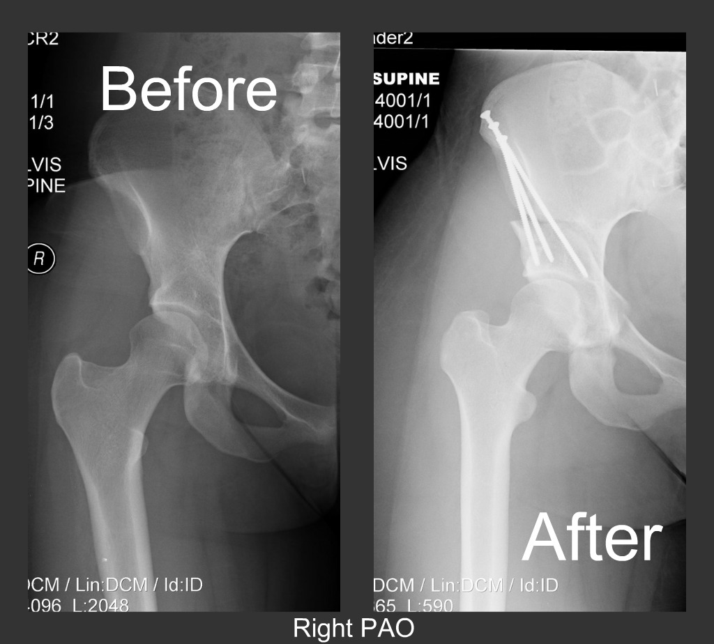 Hypermobility hypermobile disorders ehlers Periacetabular Osteotomy (PAO) ~ Living with Ehlers Danlos Syndrome
