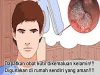 Obat Kutil Kelamin Dan Kutil Kelamin Manjur