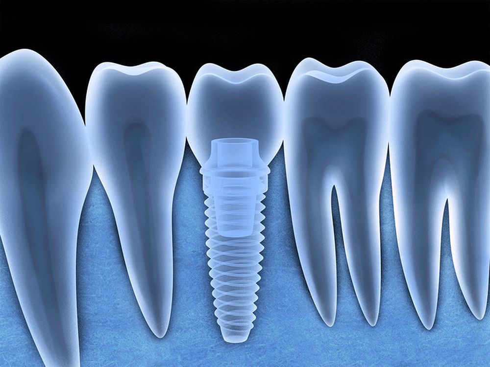 What are the risks of Dental Implants Directorio Odontológico