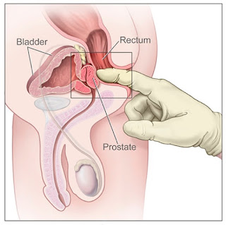 https://thaiprostatecancer.com/basic-prostate-cancer-screening-methods/