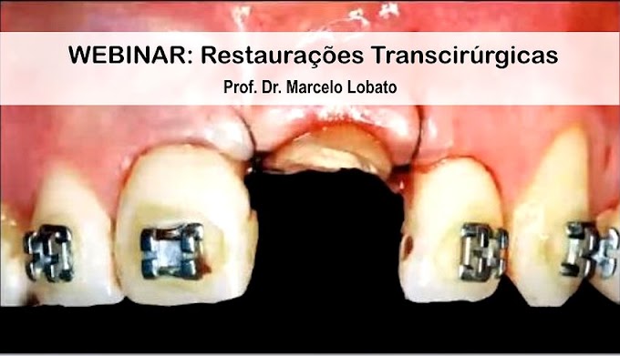WEBINAR: Restaurações Transcirúrgicas - interrelação estética / periodontia - Prof. Dr. Marcelo Lobato