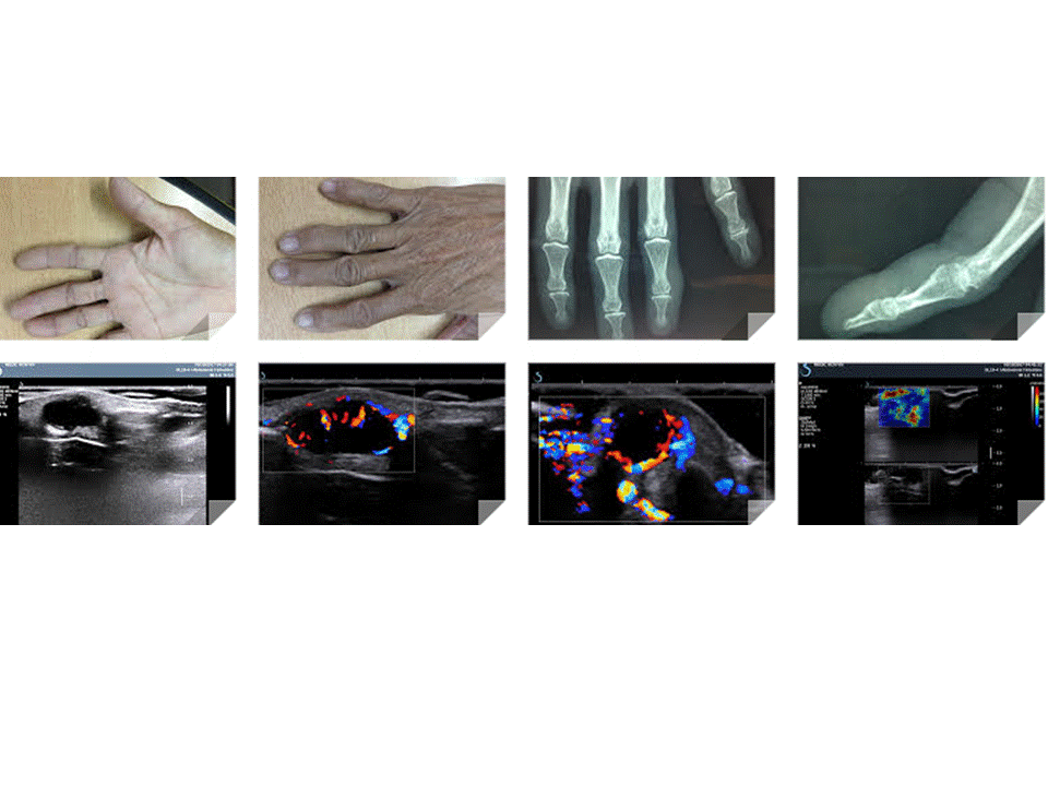 VIETNAMESE MEDIC ULTRASOUND CASE 455 FINGER TUMOR, Dr PHAN THANH HAI