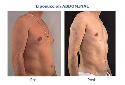 liposuccion_abdominal.jpg