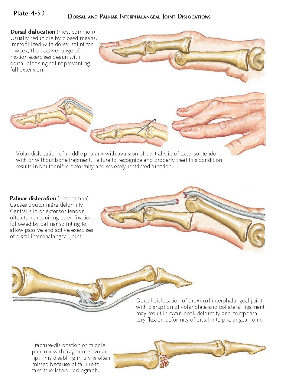 DISLOCATION OF PROXIMAL INTERPHALANGEAL JOINT pediagenosis