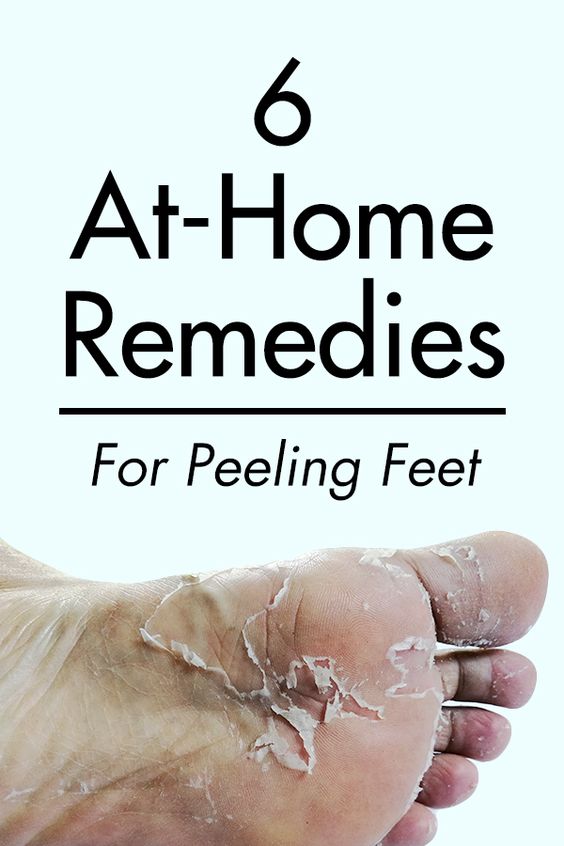 How to Get Rid of Calluses 6 AtHome Methods Home Remedies
