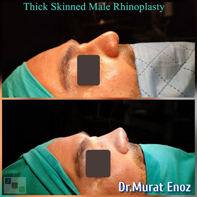 Male Nose Job,Thick Skinned Male Rhinoplasty,Rhinoplasty in Men Istanbul,