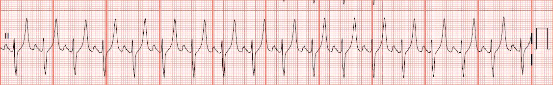 EKG Rhythm Strips: Hyperkalemia part 2