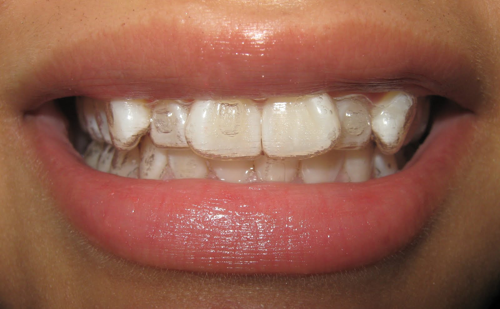 invisalign tray attachments trays ndy br journey