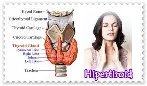 hipertiroidisme-www.healthnote25.com