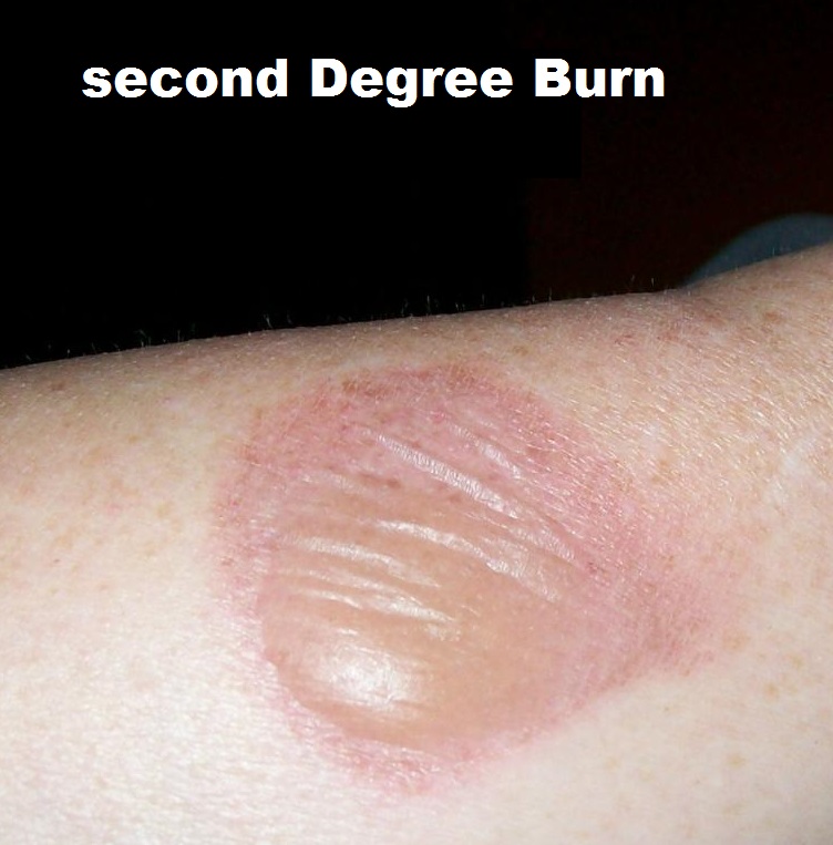 Skin Burn home management part 1. akufisio.blogspot