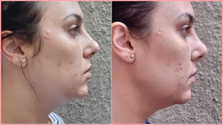 Doses Concentradas de Preenchimento Facial Renew Avon resenha dicas da tia antes e depois 1