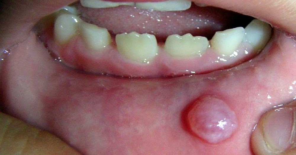 Diagnóstico e Tratamento de Mucocele em Odontopediatria Relato de Caso odontobebe