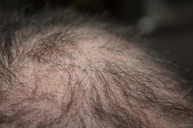 ALL YOU NEED TO KNOW ABOUT HAIR LOSS AND ITS TREATMENT