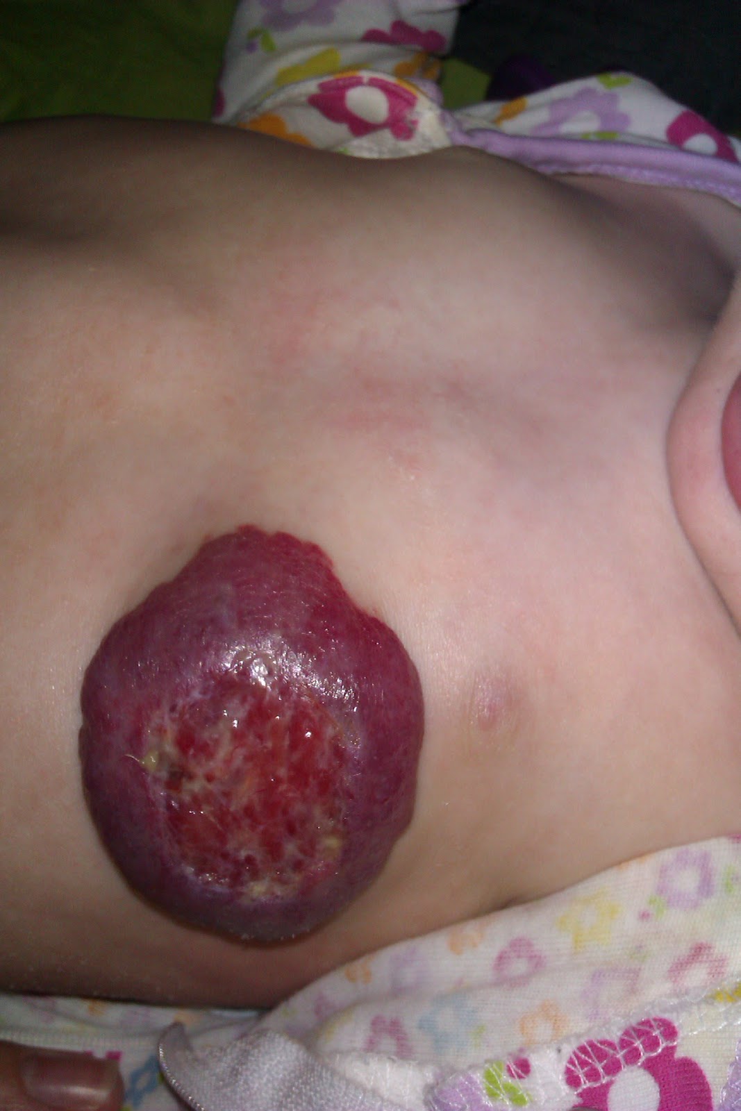 propranolol for hemangioma #11