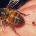 If bee stings, do it at home, treatment will not come, swelling
| Timesok.com
