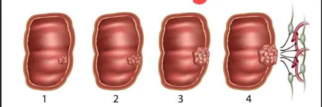 صورة توضح مراحل سرطان القولون