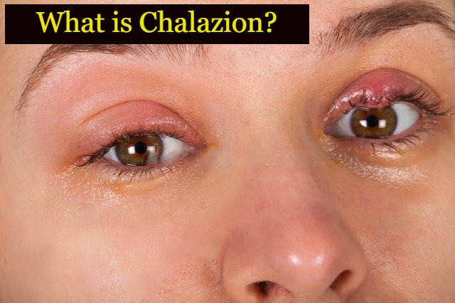 how-to-get-rid-of-a-chalazion-fast-treatment