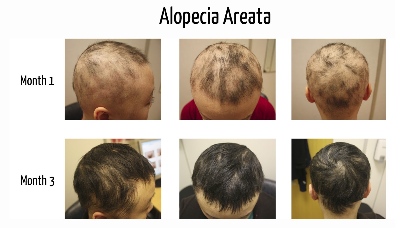 Alopecia Areata All You Need To Know The Belgravia Centre