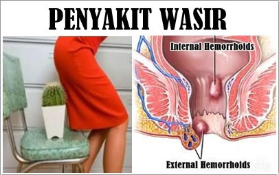 gambar penyakit wasir ambeien