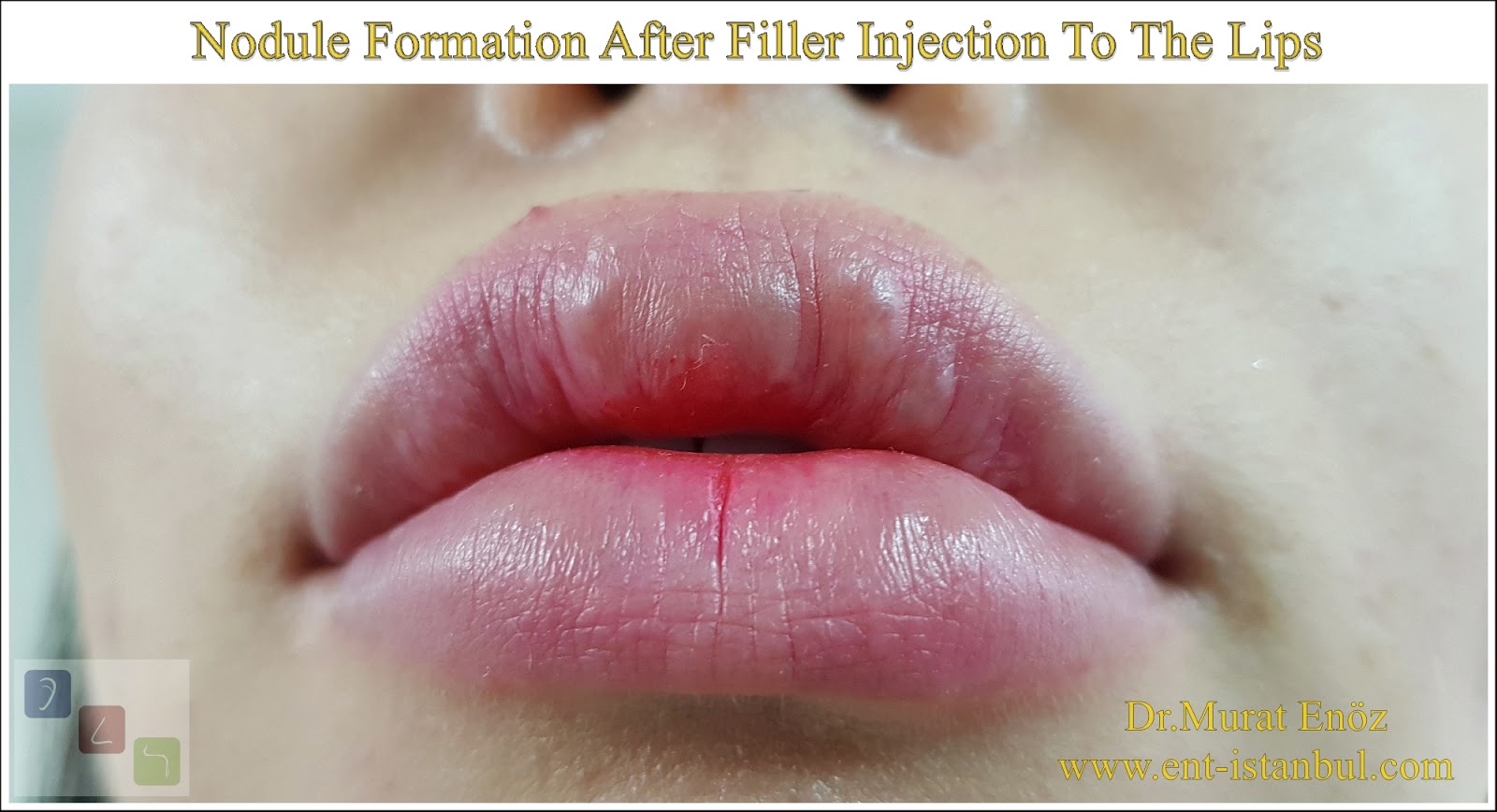 Eating, Sleeping and Kissing After Lip Filler Injections