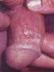 Sipilis di penis Sipilis di penis