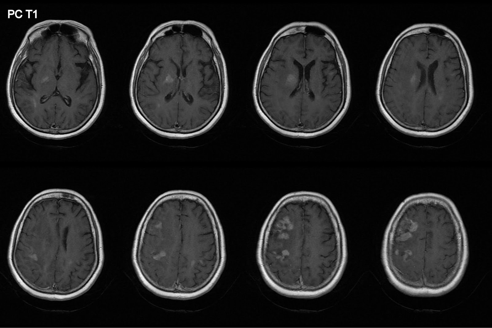 creatinine istat venous mri creatinine istat venous mri