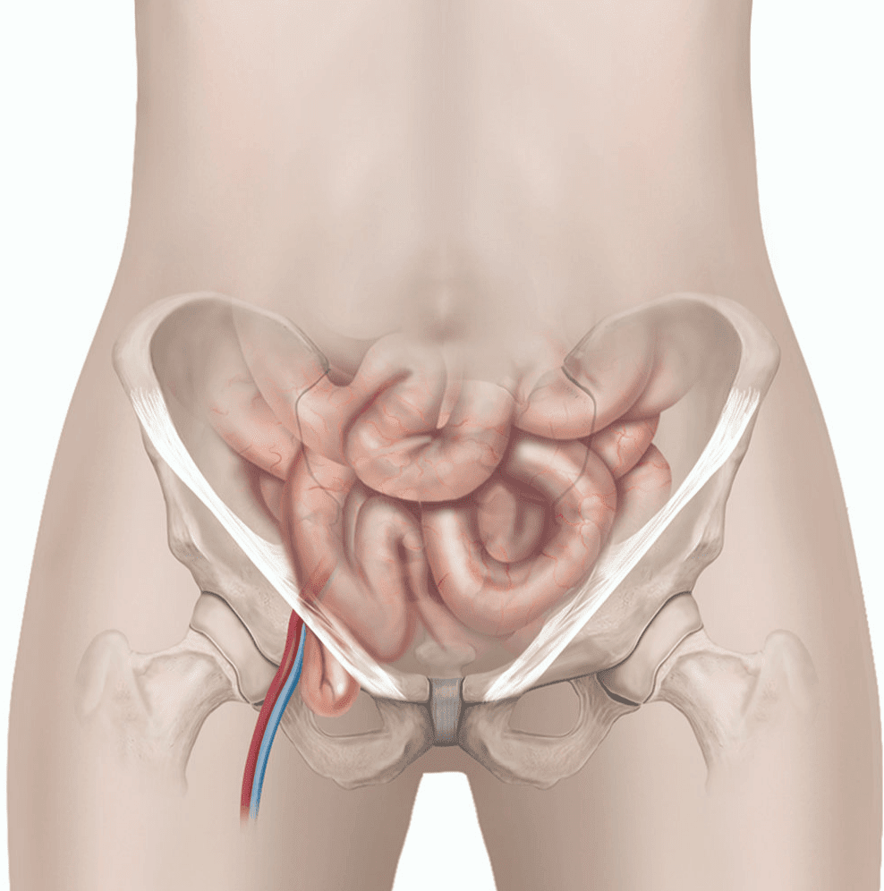 femoral fitik femorel herni nedir