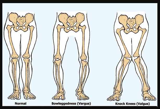 Dua orang siswa memilik bentuk tulang kaki yang menyerupai huruf X dan