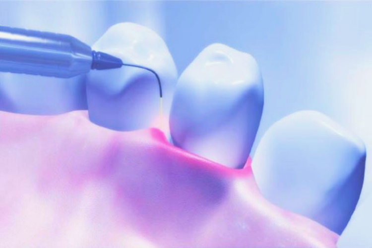 Лазерное десен. Эрбиевый лазер в стоматологии. Лазер хирургический стоматологический. Лазерная терапия десен. Эрбиев лазер стоматологи.