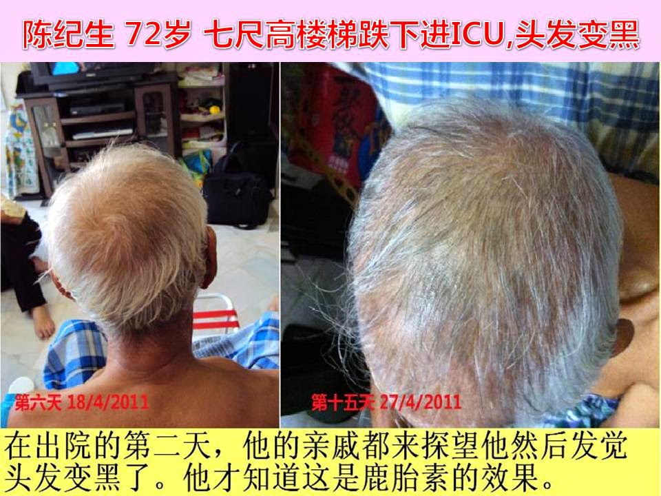 TAN KEE SANG (72 YEARS O) - FALL FROM 7FT HEIGHT LADDER AMITTED INTO ICU, HAIR GROW TO DARKER COLOR