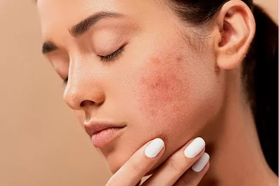 home remedy to remove spots from face naturally in hind home remedy to remove spots from face naturally in hind