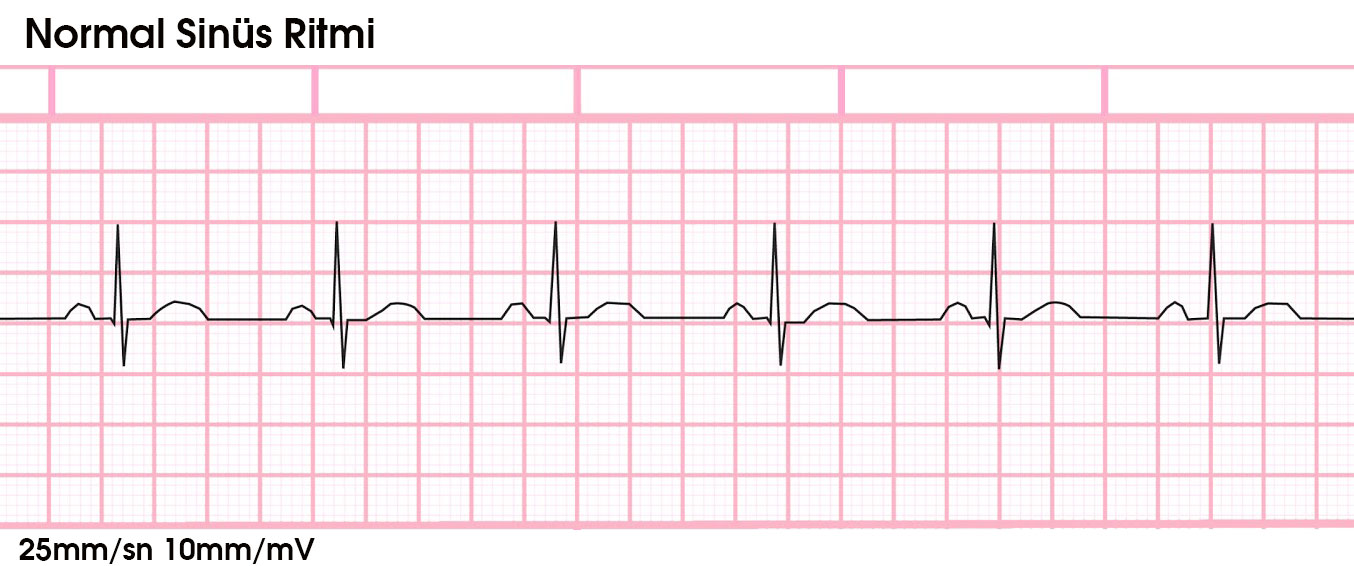 Ekg Temel Bilgiler Bradikardi Av Bloklar