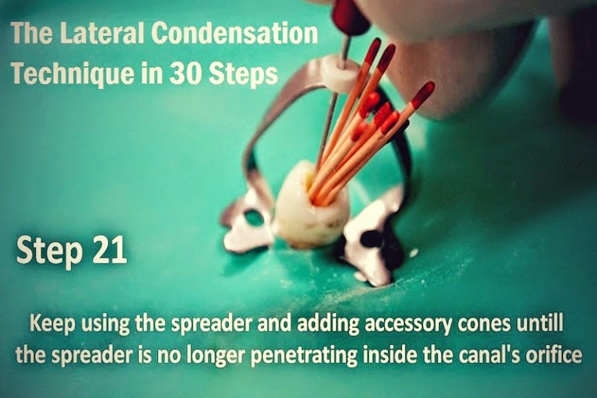 ENDODONTIC The Lateral Condensation Technique in 30 Steps
