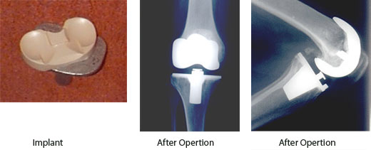 Joint Replacement Surgery in India Knee Joint Replacement